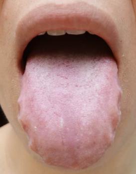舌头长泡是什么原因怎么治疗 舌头长泡是怎么回事啊  第1张