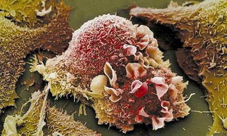 中央型肺癌晚期症状 中央型肺癌晚期症状是什么  第3张