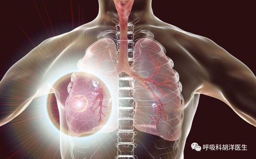 中央型肺癌晚期症状 中央型肺癌晚期症状是什么  第2张